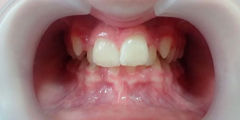 До - Ультразвуковая чистка